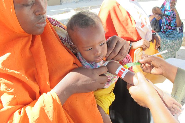 We onderzoeken dit kind op ondervoeding in Somalië | Artsen zonder Grenzen