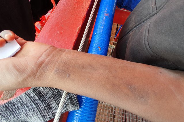 Marina toont de littekens op haar arm. © MSF/Stefan Dold