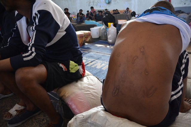 Littekens bij man in detentiecentrum Zintan, Libië. © Jérôme Tubiana/MSF