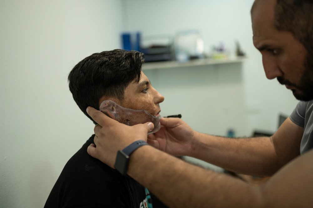 Ali (15) uit Irak ondergaat specialistische brandwondenzorg in ons ziekenhuis in Jordanië. © Rehab Eldalil/MSF