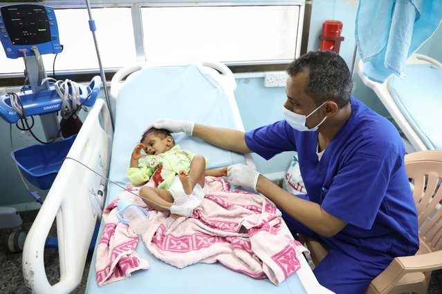 Artsen zonder Grenzen verpleegkundige zorgt voor kinderen met ondervoeding in ziekenhuis Jemen