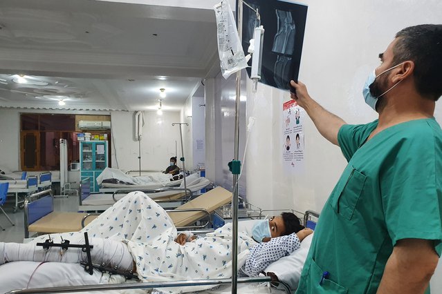 Een hulpverlener onderzoekt de röntgenfoto van een patiënt met een gecompliceerde breuk in zijn boven- en onderbeen. © Stig Walravens/MSF