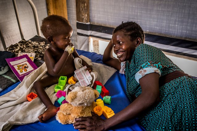 Een vluchteling wordt behandeld voor ondervoeding in Uganda.