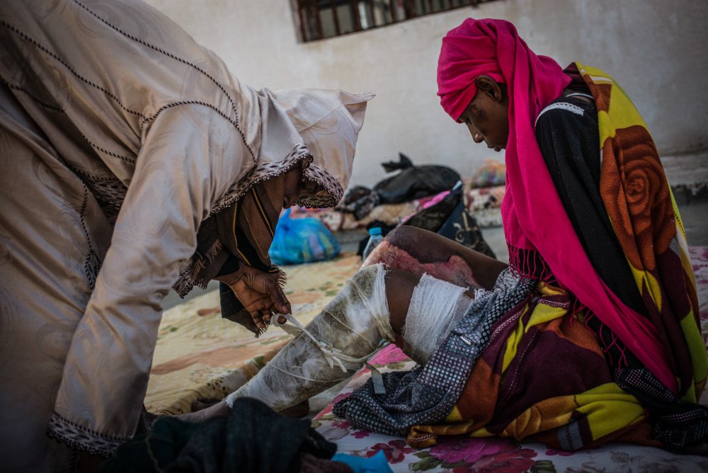Een vrouw heeft brandwonden aan haar been in een detentiecentrum in Libië.