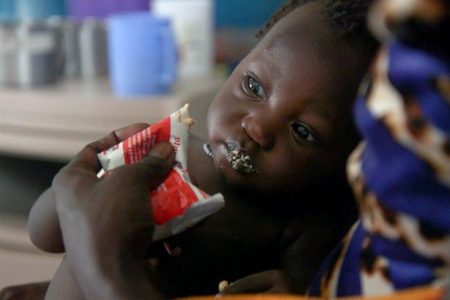 Een ondervoed kindje in onze kliniek in Pibor, Zuid-Sudan