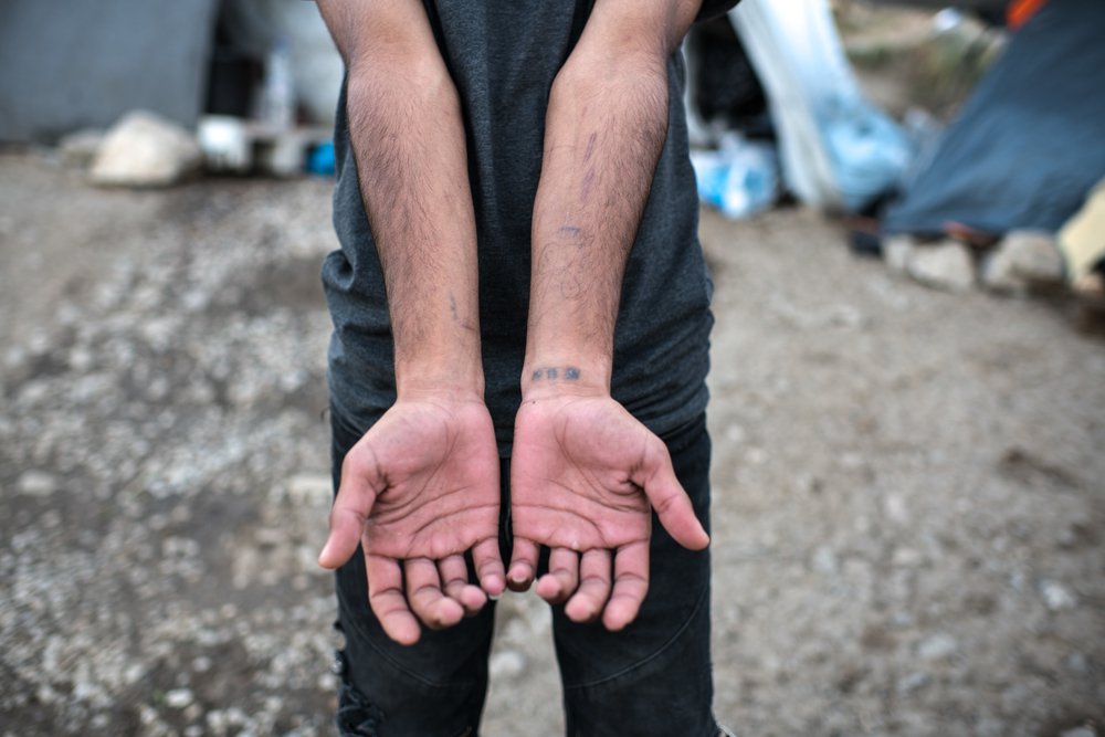 Vluchteling toon zijn polsen, in vluchtelingenkamp in Moria, Griekenland