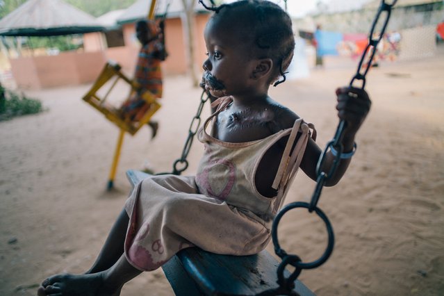 Maryan kreeg een hersteloperatie, noma, Nigeria | Artsen zonder Grenzen