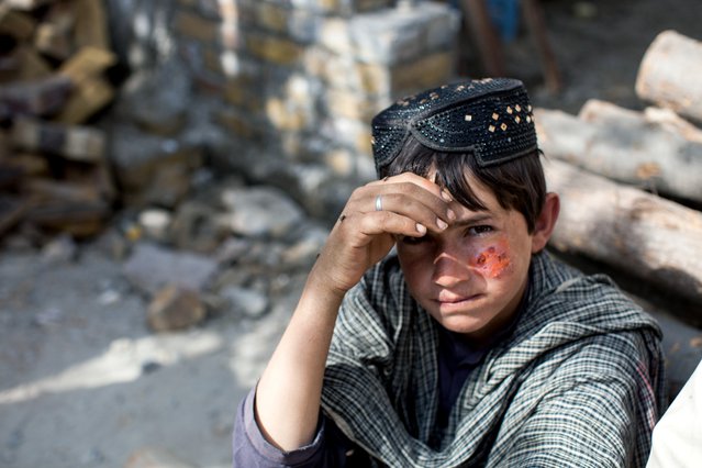 Cutaneous Leishmaniasis behandeling, Kuchlak, Pakistan | Artsen zonder Grenzen