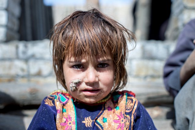 Cutaneous Leishmaniasis behandeling, Kuchlak, Pakistan | Artsen zonder Grenzen