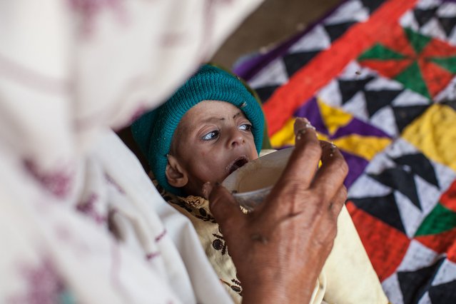 Artsen zonder Grenzen behandelen ondervoeding Pakistan